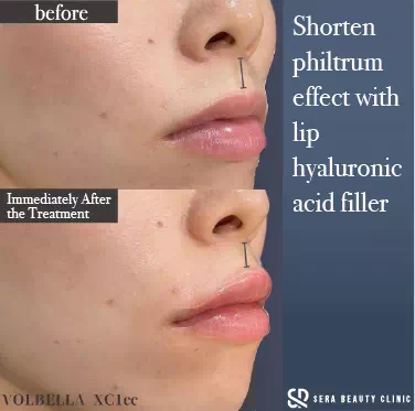 Designing your ideal lips