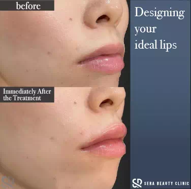 Shorten philtrum effect with lip hyaluronic acid filler