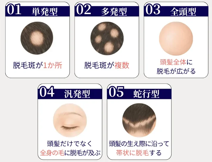 円形脱毛症の種類 単発型 多発型 全頭型 汎発型 蛇行型