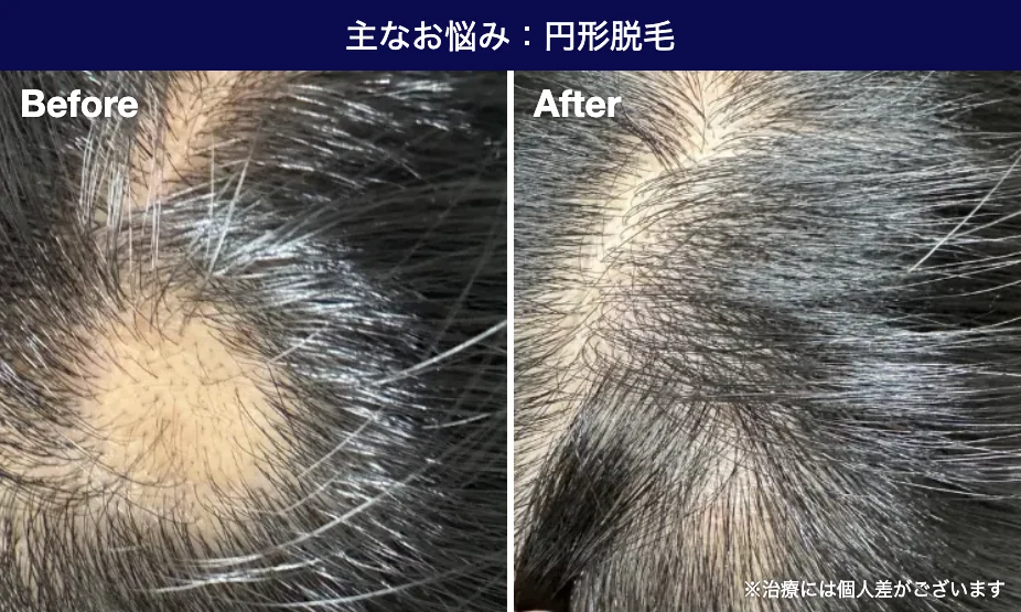 セラビ式ヘアグロウ注射の症例 円形脱毛 Before After