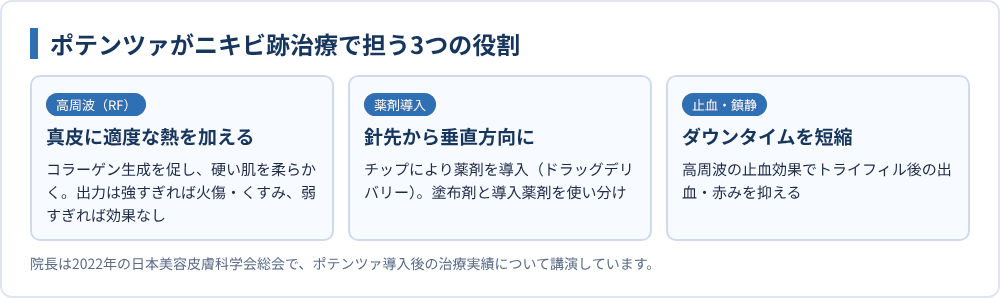 ポテンツァがニキビ跡治療で担う3つの役割